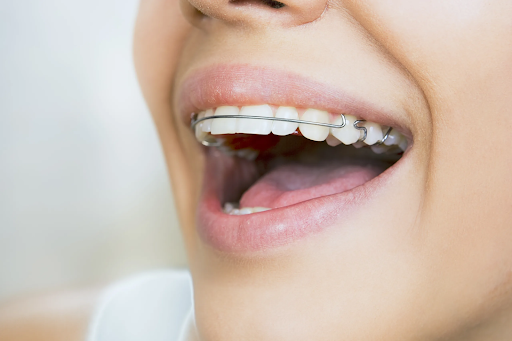 If I Start Wearing My Retainer Again, Will My Teeth Move Back?