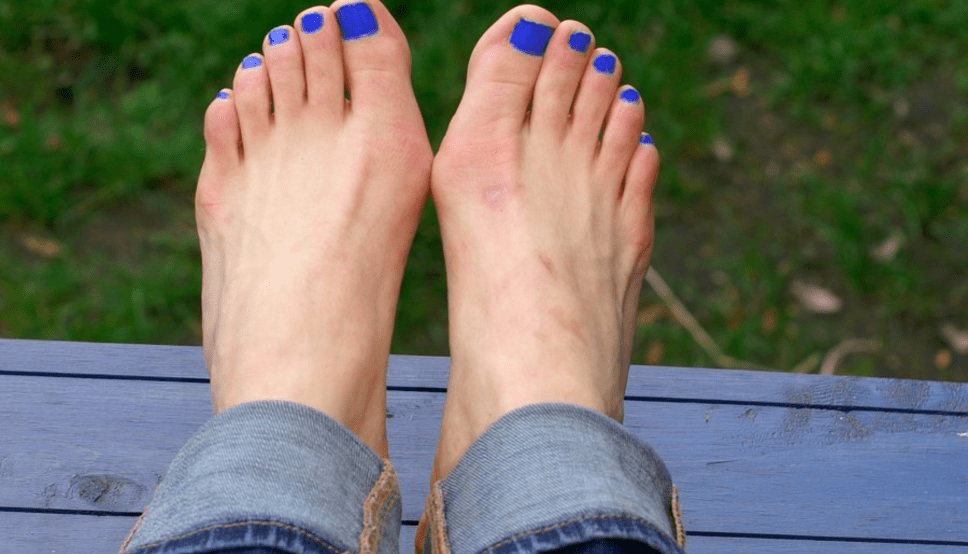 Treating Bunions: Traditional vs. Minimally Invasive Bunion Surgery