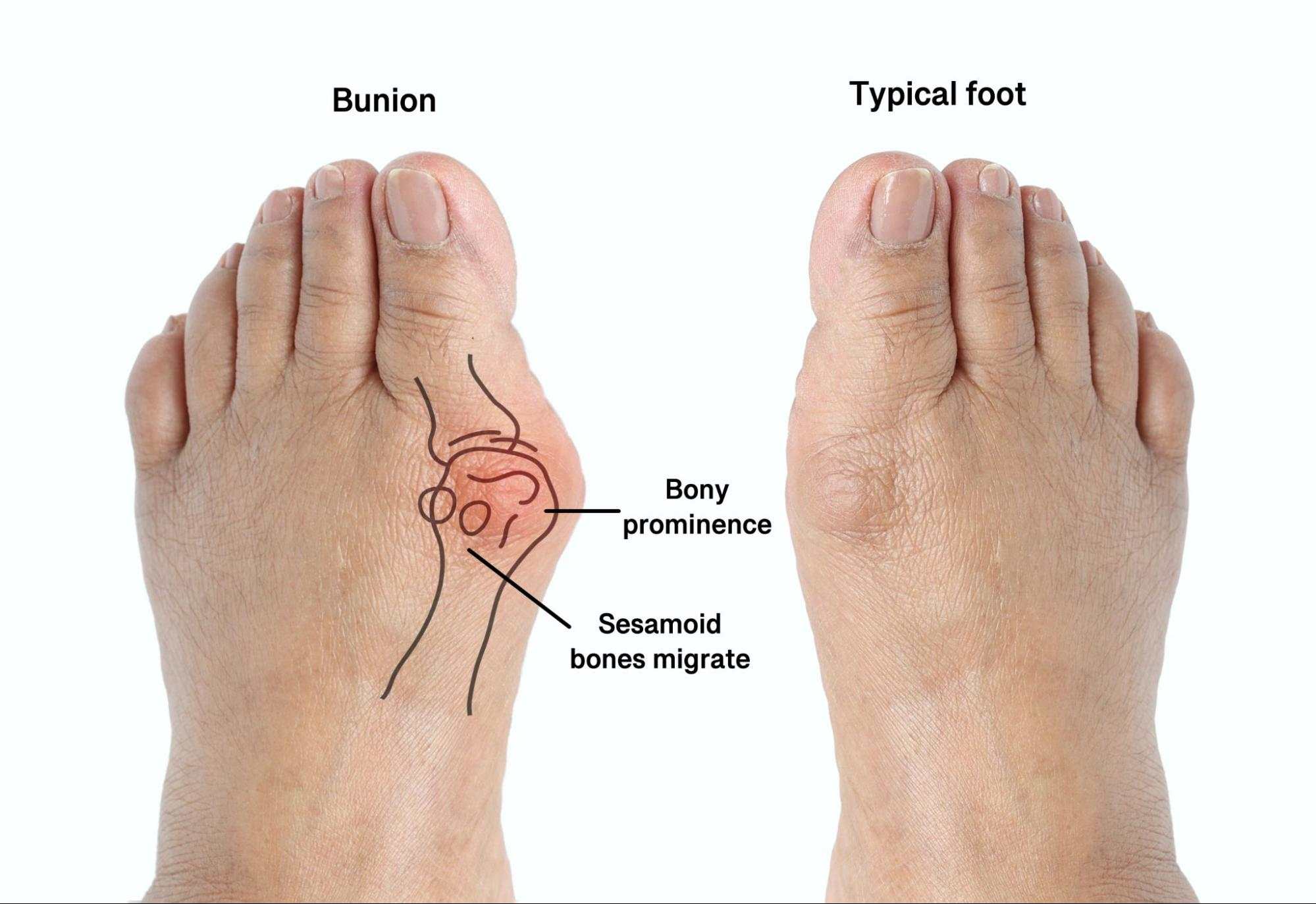 How Soon Can I Walk After Bunion Surgery?