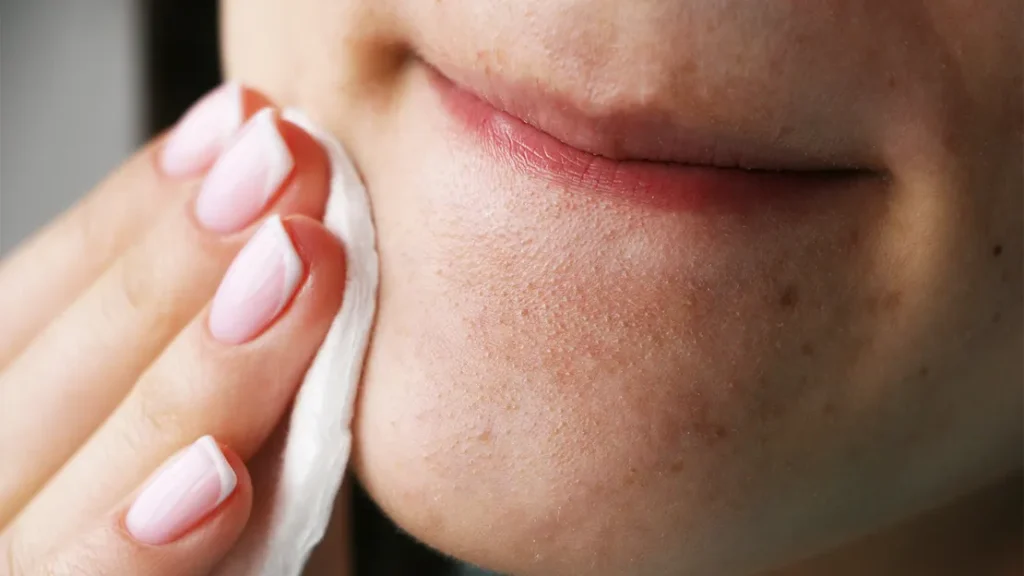 The Best and Worst Ways to Get Rid of Blackheads